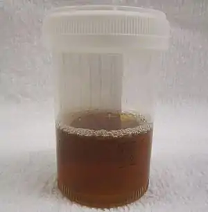 A container half-full with brown-stained urine, characteristic for rhabdomyolysis