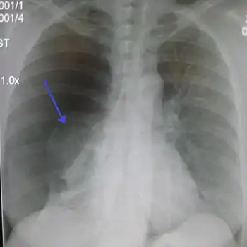 Chest X-ray showing a pneumothorax on the right (left in the image), where the absence of lung markings indicates that there is free air inside the chest