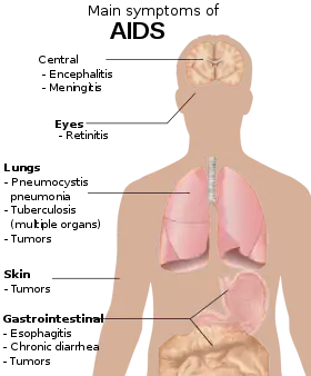 A diagram of a human torso labelled with the most common symptoms of AIDS