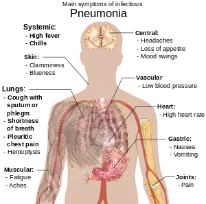 A diagram of the human body outlining the key symptoms of pneumonia