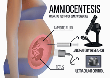 Amniocentesis