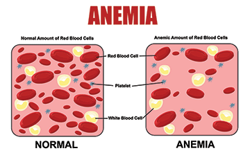 Anemia