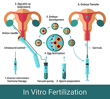 Artificial insemination