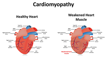 Cardiomyopathy