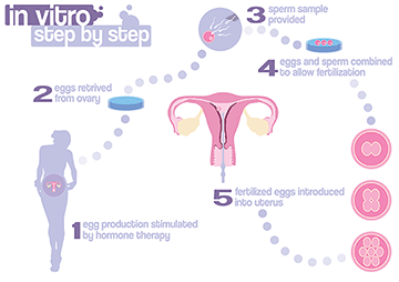 In vitro fertilization (IVF)