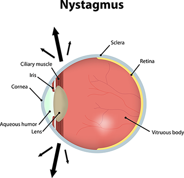 Nystagmus