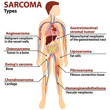 Sarcoma