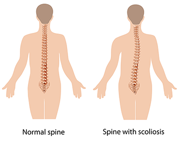 Scoliosis