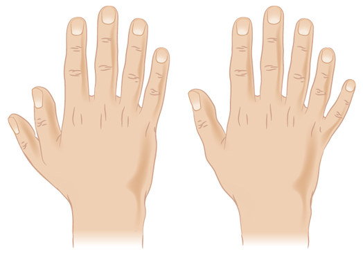 Polydactyly