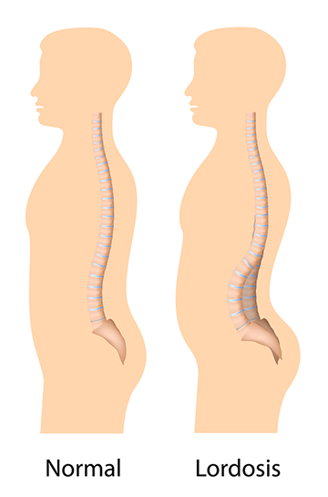 Lordosis