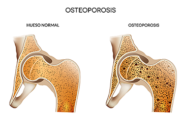 Osteoporosis