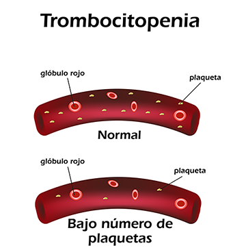 Trombocitopenia