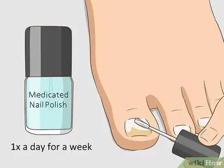 Image titled Hide Nail Fungus Step 13