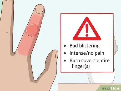 Image titled Treat a Blistering Burn on Your Finger Step 4