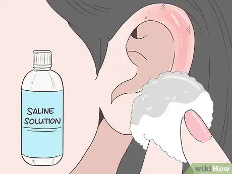Image titled Reduce Ear Swelling Step 7