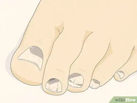 Image titled Know if You Have Neuropathy in Your Feet Step 4