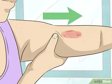 Image titled Get Rid of Burn Scars Step 7