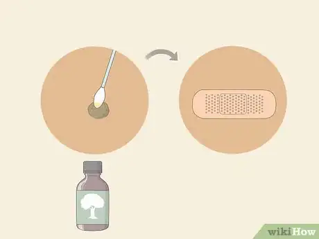 Image titled Get Rid of Warts Step 15