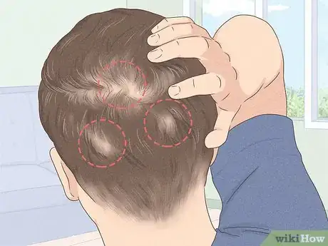 Image titled Know if You Have Male Pattern Baldness Step 2