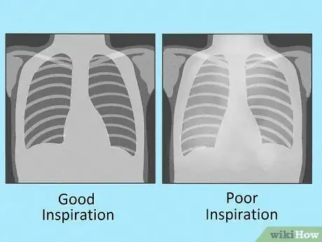 Image titled Know if a Chest X Ray Film Is Rotated Step 10