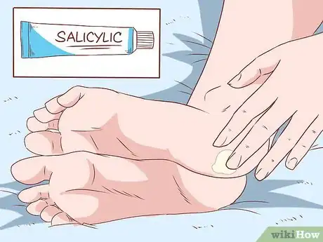 Image titled Get Rid of Calluses on Feet Step 5
