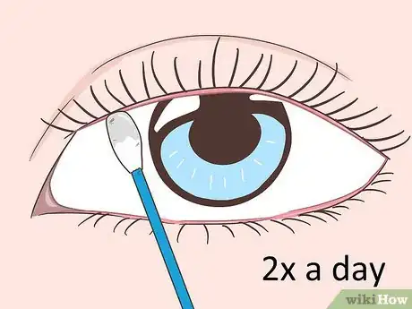 Image titled Treat Ocular Rosacea Step 3