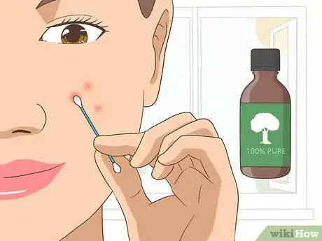 Image titled Use Tea Tree Oil for Acne Step 5