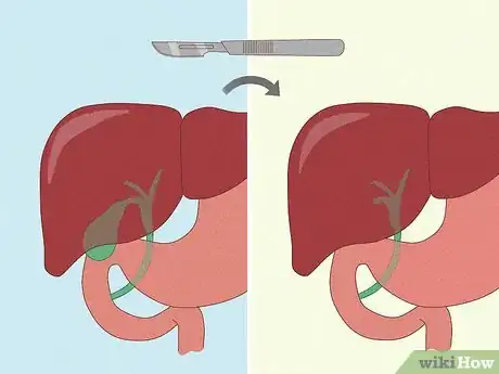 Image titled Get Rid of Gallstones Step 15