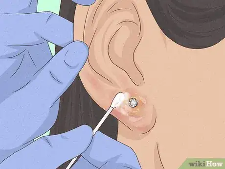 Image titled Clean a New Ear Piercing Step 21