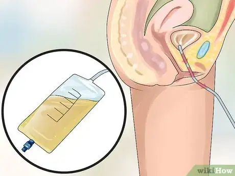 Image titled Use a Catheter Step 5