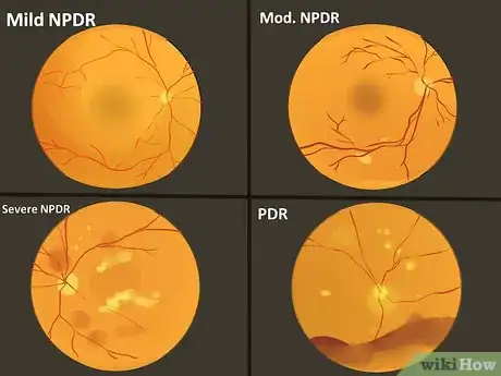 Image titled Treat Diabetic Retinopathy Step 1