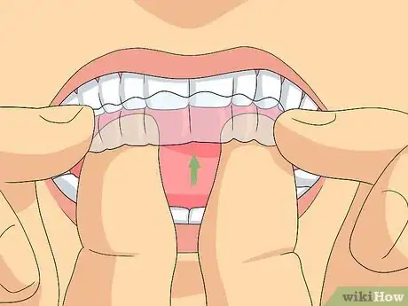 Image titled Clean Invisalign Step 5