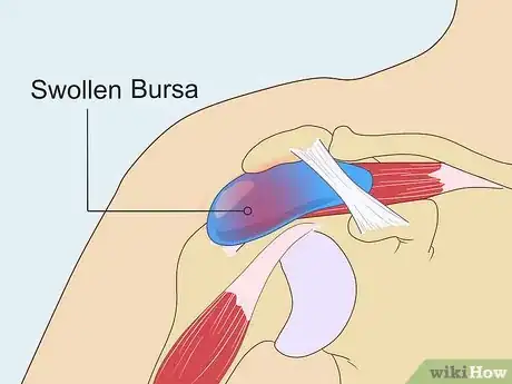 Image titled Treat Subacromial Bursitis Step 2