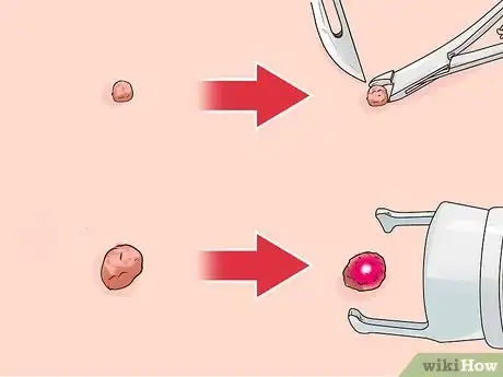 Image titled Get a Wart Surgically Removed Step 2