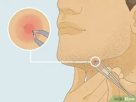 Image titled Get Rid of Razor Bumps on Your Neck Step 6