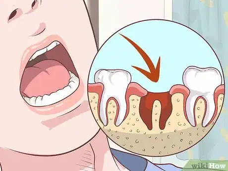 Image titled Prepare for Tooth Extraction Step 17