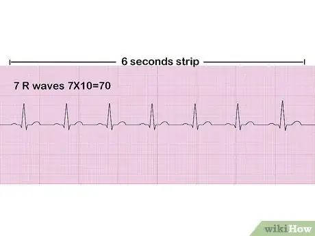 Image titled Read an EKG Step 7