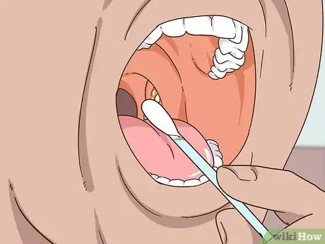 Image titled Prevent Tonsil Stones Step 4