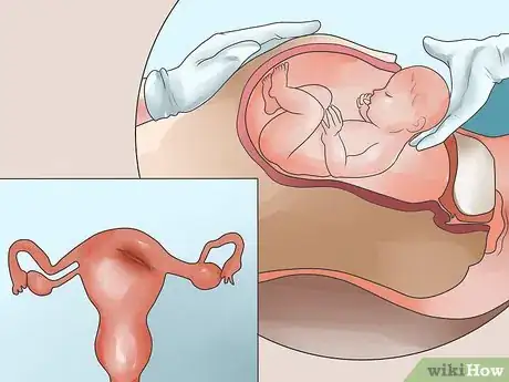Image titled Recognize Symptoms of a Postpartum Hemorrhage Step 3