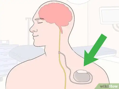 Image titled Stimulate the Vagus Nerve Step 10