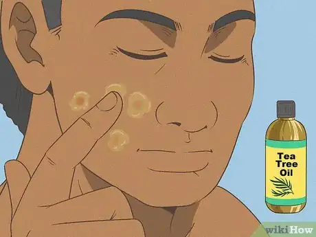 Image titled Reduce Pimple Redness and Size (Aspirin Method) Step 6