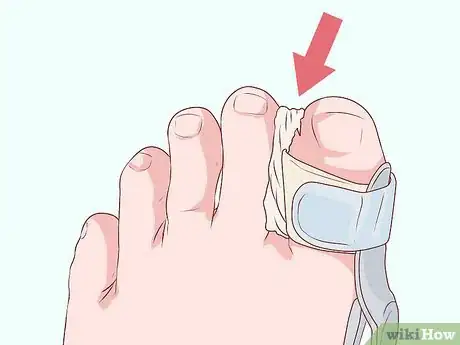 Image titled Bandage Fingers or Toes Step 22