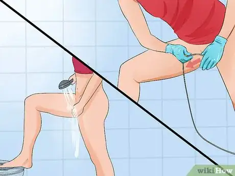 Image titled Use a Catheter Step 6