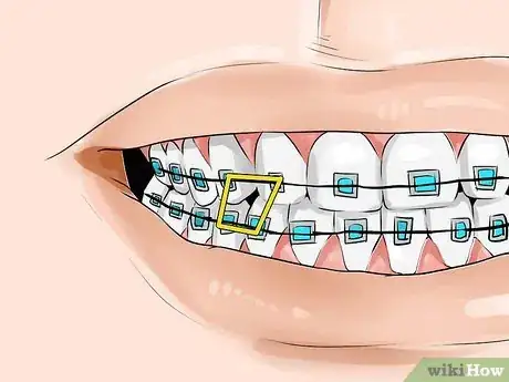 Image titled Connect a Rubber Band to Your Braces Step 6