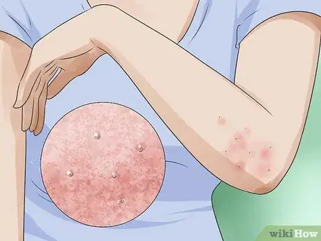 Image titled Recognize Scabies Rash Step 4