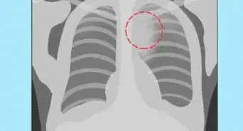 Know if a Chest X Ray Film Is Rotated
