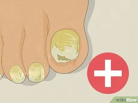 Image titled Treat Toe Nail Fungus Step 12