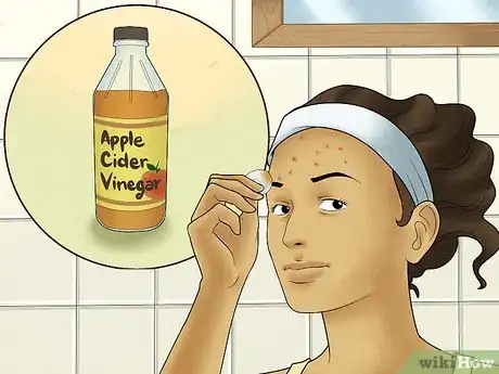 Image titled Get Rid of Forehead Acne Step 6