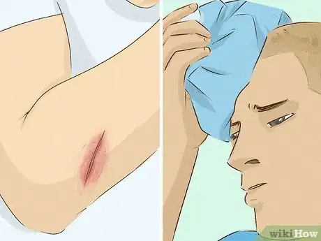 Image titled Heal Cuts Quickly (Using Easy, Natural Items) Step 19