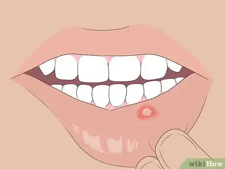 Image titled Get Rid of Mouth Blisters Step 7